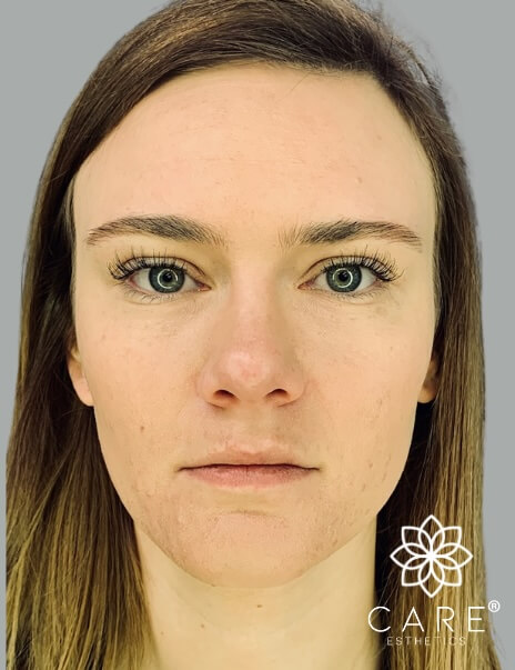 Facial Esthetics After 1