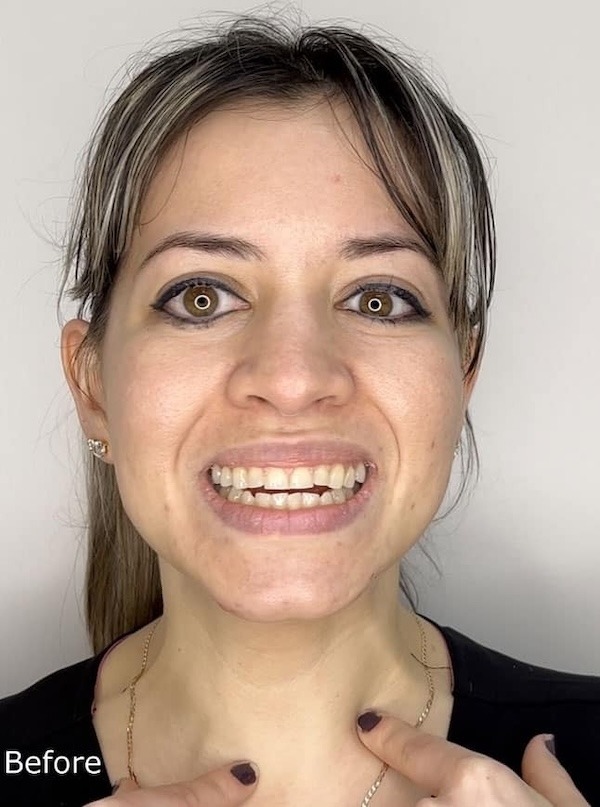 Smile makeover before