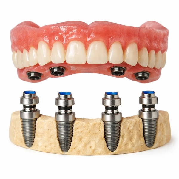 Snap-on Dentures in Plantation, FL