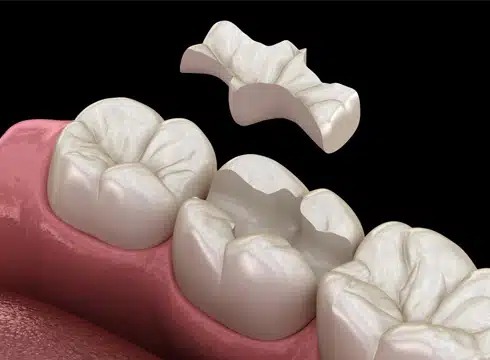 Dental Onlays in Plantation, FL