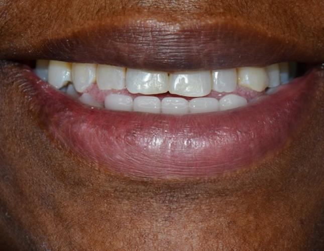 Six Month Smile 1 After