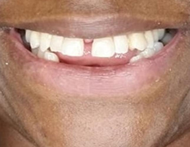 Six Month Smile 1 Before