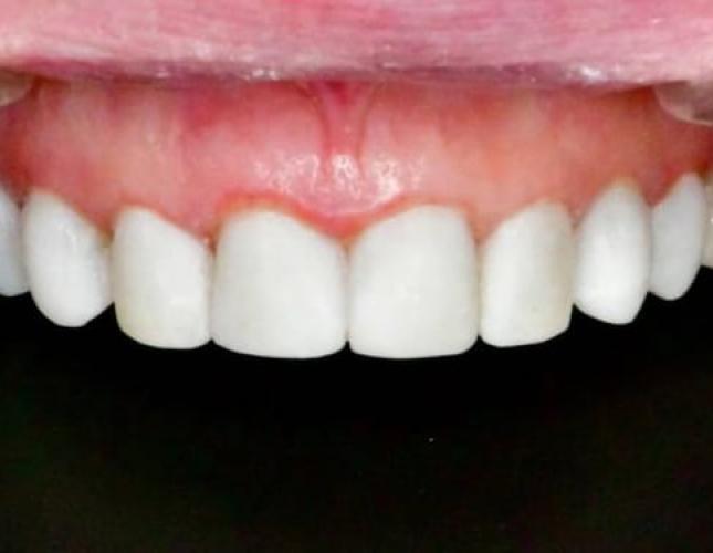 Composite Bonding 1 After