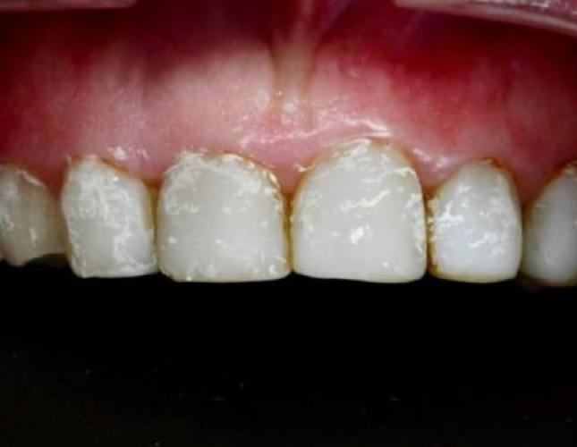 Composite Bonding 1 Before