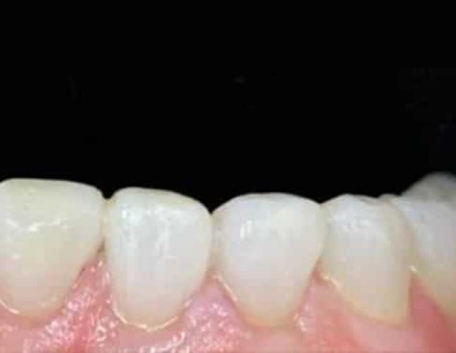 Composite Bonding 2 After