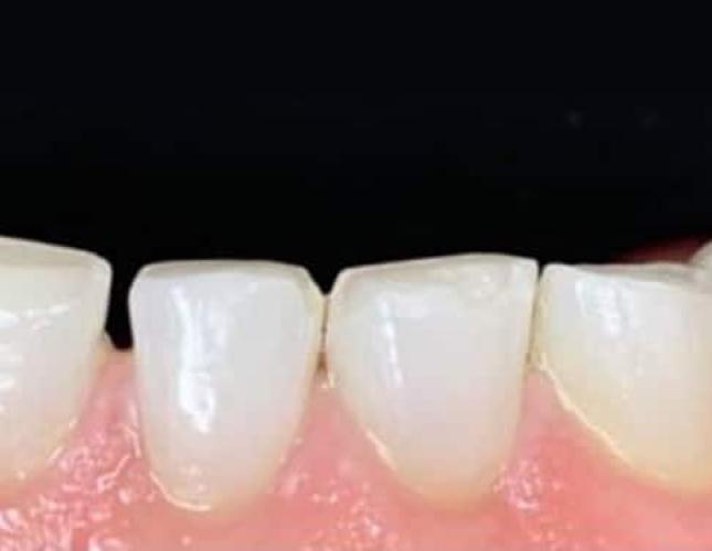 Composite Bonding 2 Before