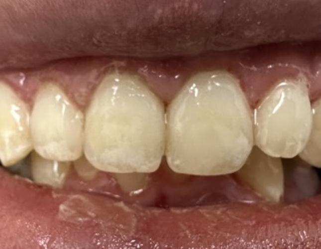 Dental Cleaning After