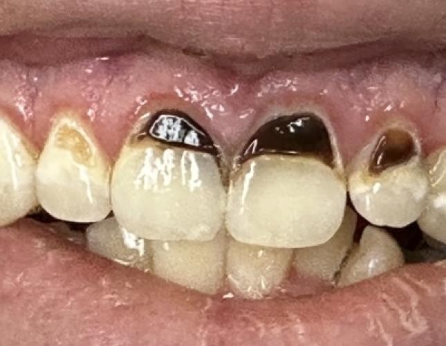 Dental Cleaning Before