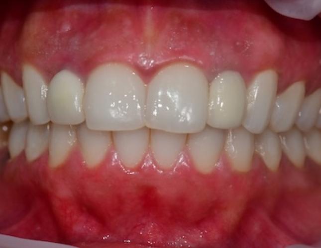 Gum Depigmentation After