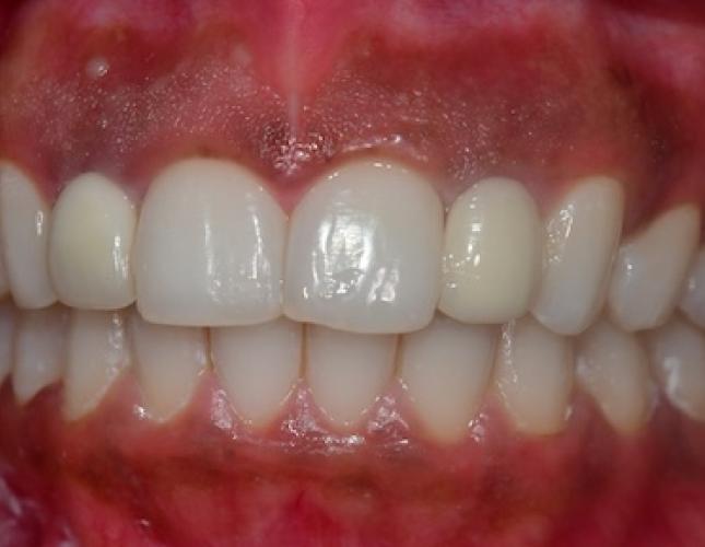 Gum Depigmentation Before