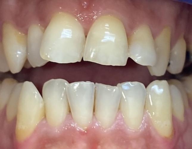 Invisalign 11 Before