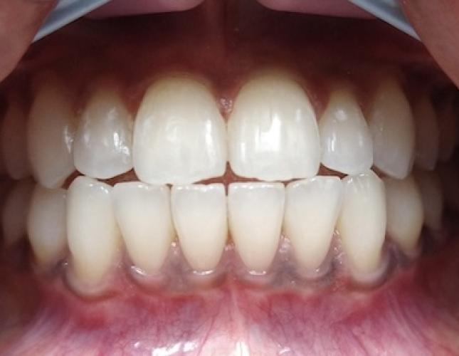 Invisalign 2 After