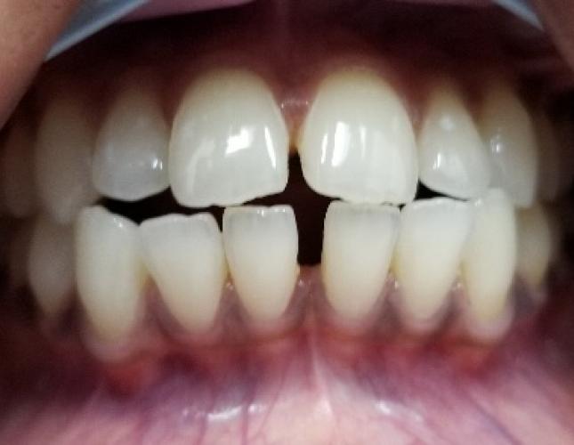 Invisalign 2 Before