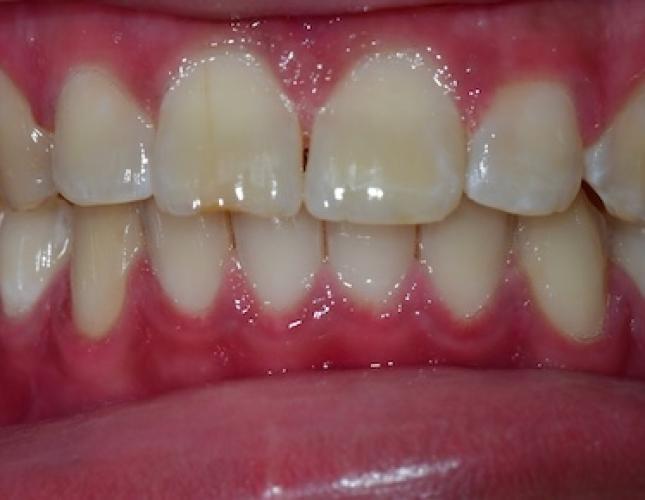 Invisalign 4 After