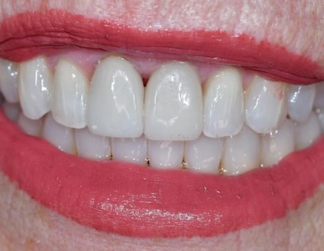 Invisalign 5 After