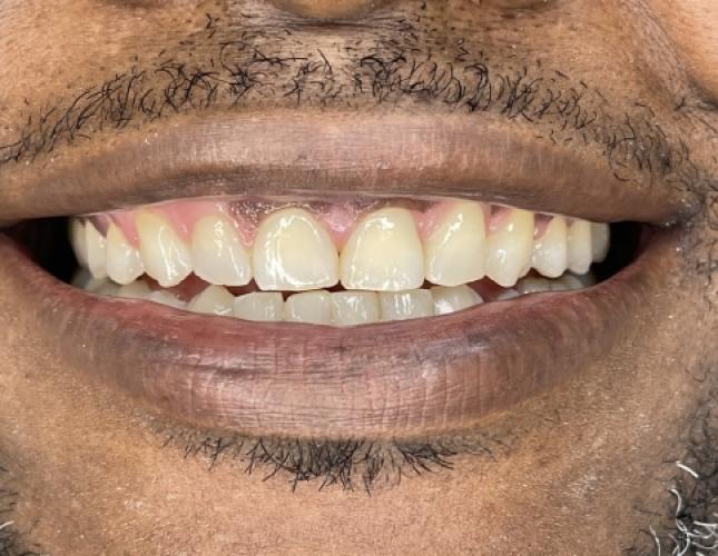 Six Month Smile 2 After