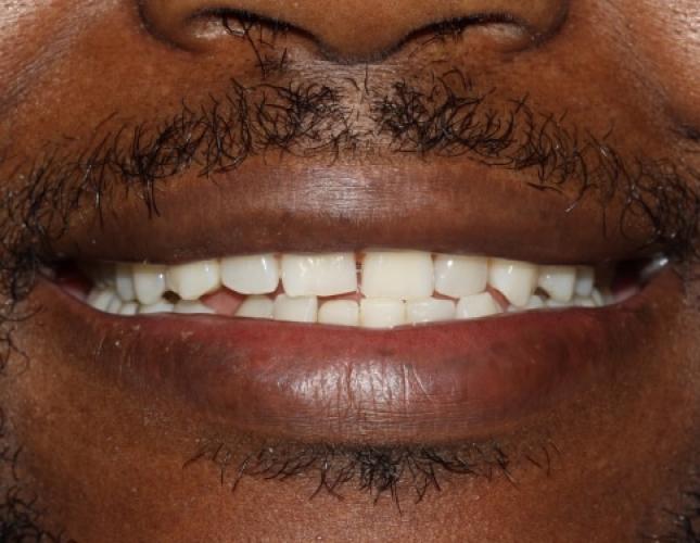 Six Month Smile 2 Before