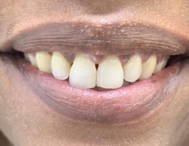 Six Month Smile 3 After