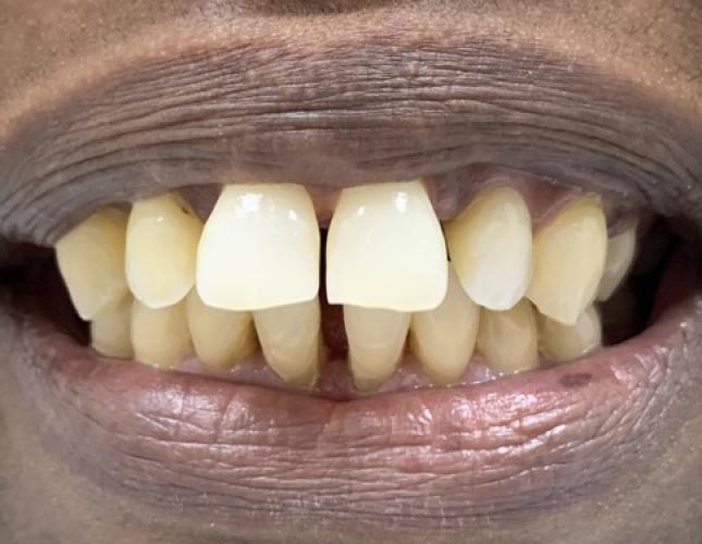 Six Month Smile 3 Before