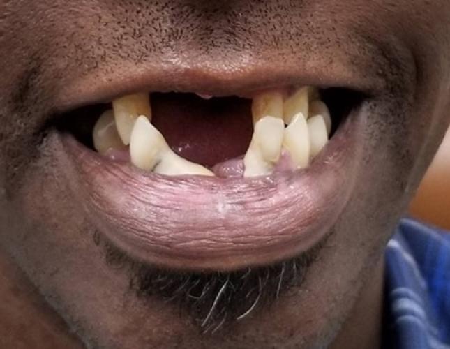 Snap-On Dentures 1 Before