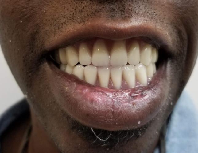 Snap-On Dentures 1 After