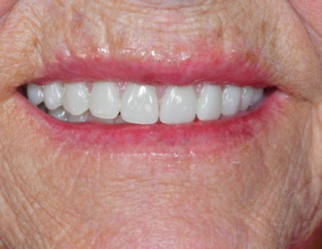 Snap-On Dentures 3 After