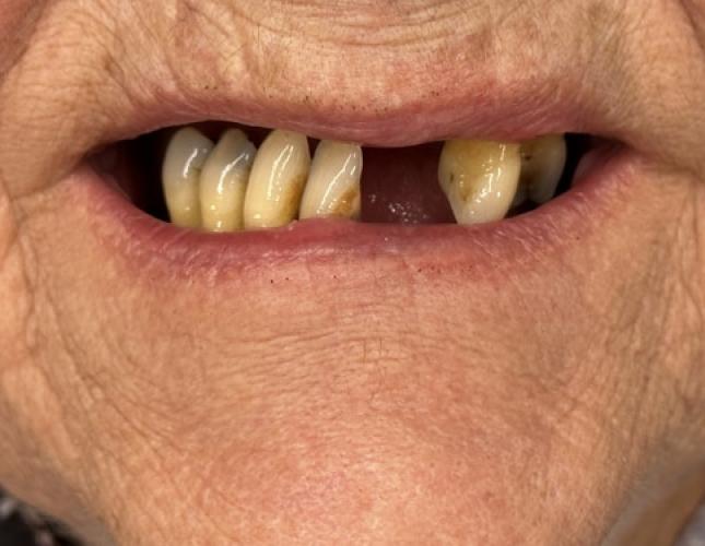 Snap-On Dentures 3 Before