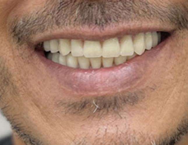 Snap-On Dentures 4 After