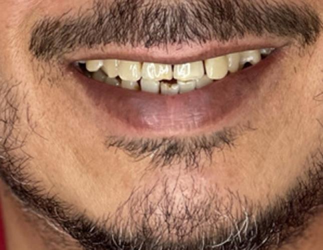 Snap-On Dentures 4 Before