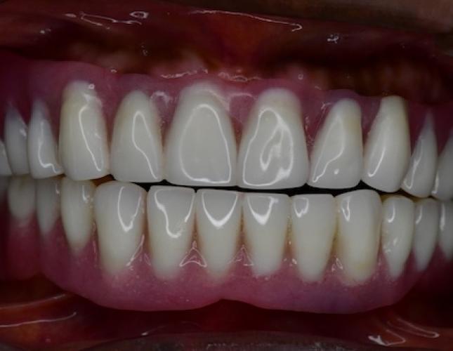 Snap-On Dentures 7 After