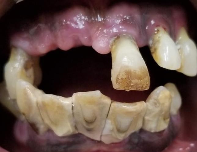 Snap-On Dentures 7 Before