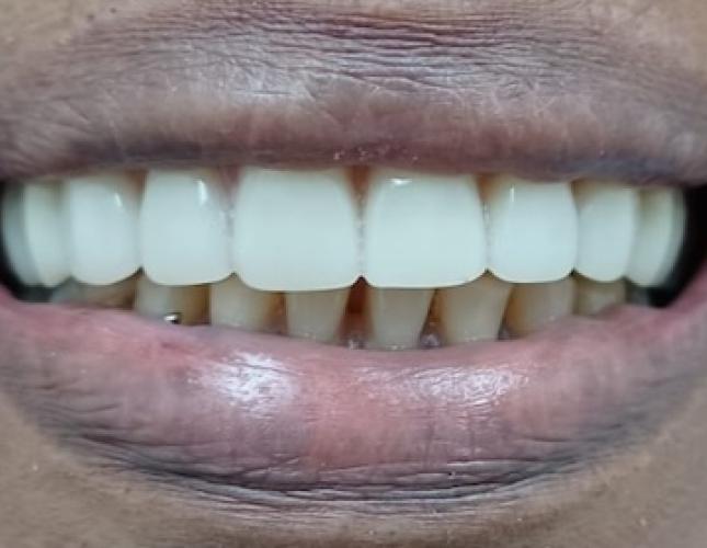 Snap-On Dentures 8 After