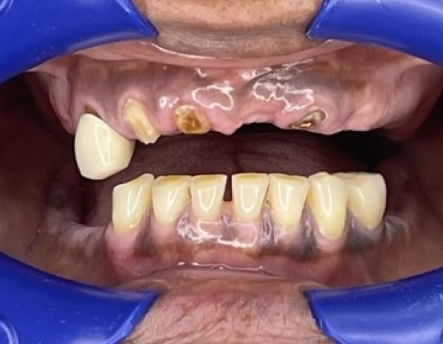 Snap-On Dentures 8 Before