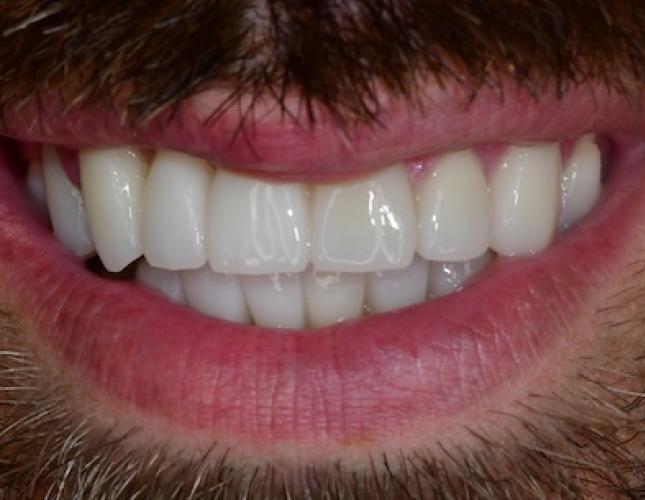 Upper & Lower Bridge After