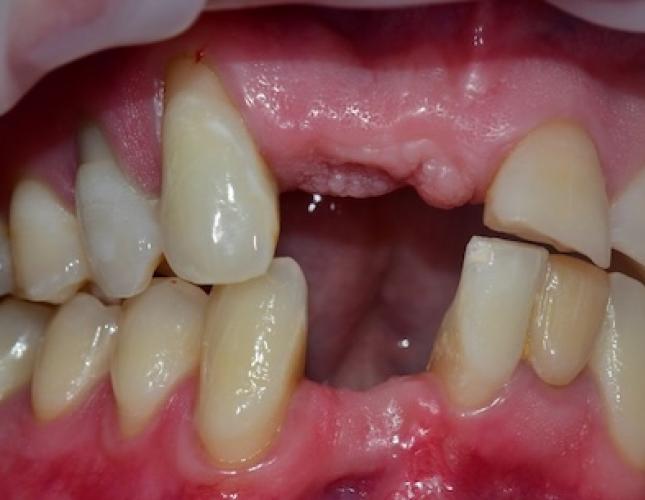 Upper & Lower Bridge Before