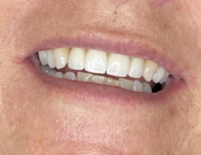 Upper Bridge 2 After