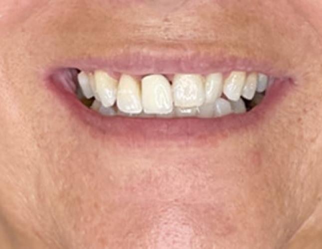 Upper Bridge 2 Before