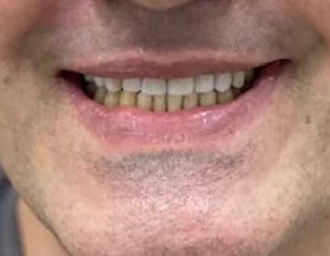 Upper Bridge 4 After