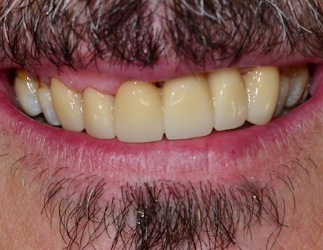 Upper Bridge 1 After