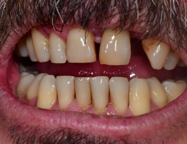 Upper Bridge 1 Before