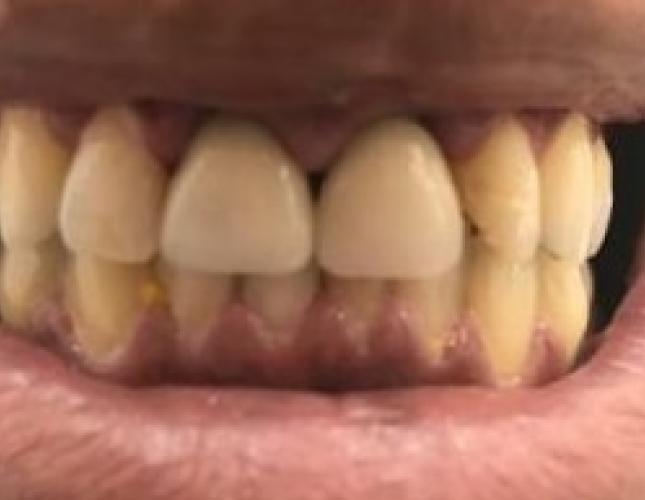 Veneers 3 After