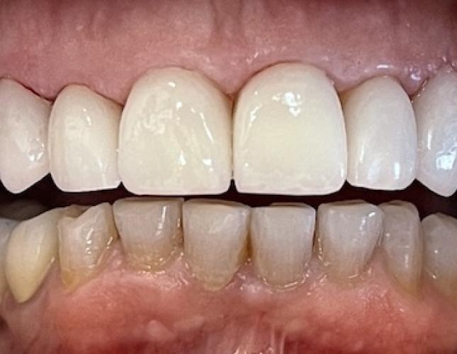 Veneers 5 After