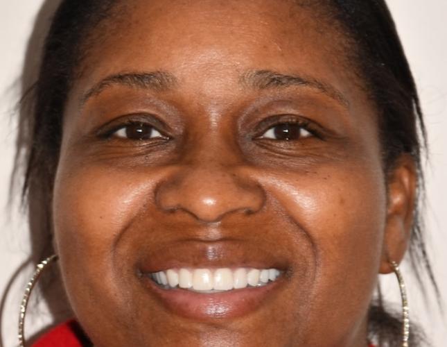 Bridge, Crowns and Veneers After