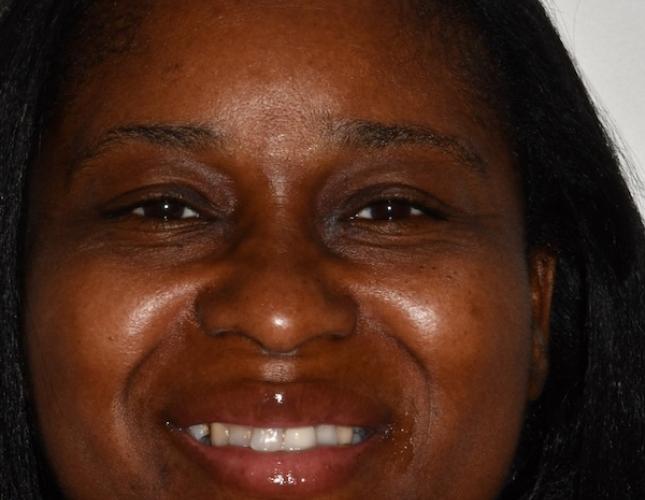 Bridge, Crowns and Veneers Before