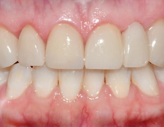 Bridge and Veneers After