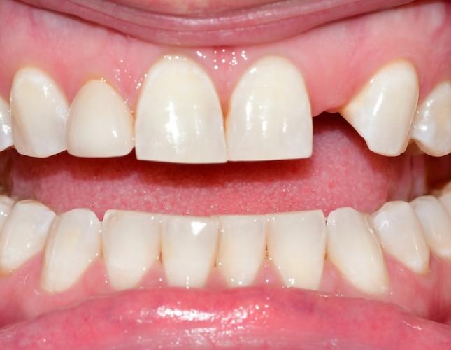 Bridge and Veneers Before