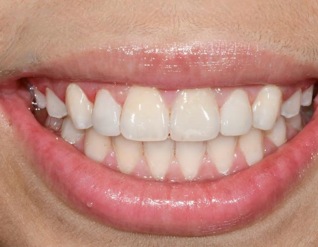 Composite Veneers 2 After