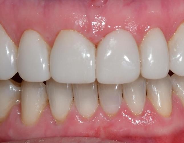 Composite Veneers After