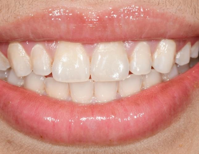 Composite Veneers 2 Before