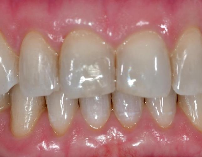 Composite Veneers Before